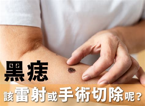 陰莖長黑痣|陰莖黑痣的手術風險與預防方法